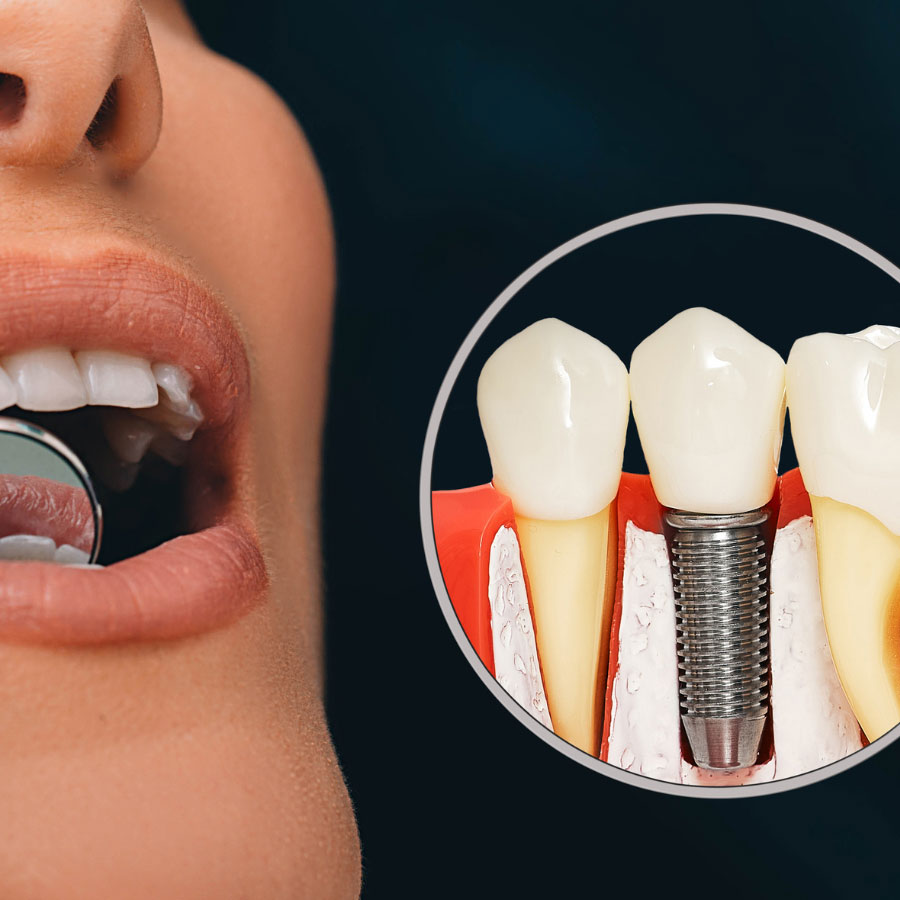 JF Studio Dentall | Implantes dentales