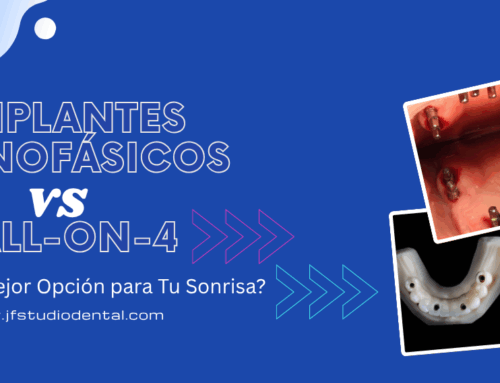 Implantes Monofásicos vs All-on-4 en Tijuana:
