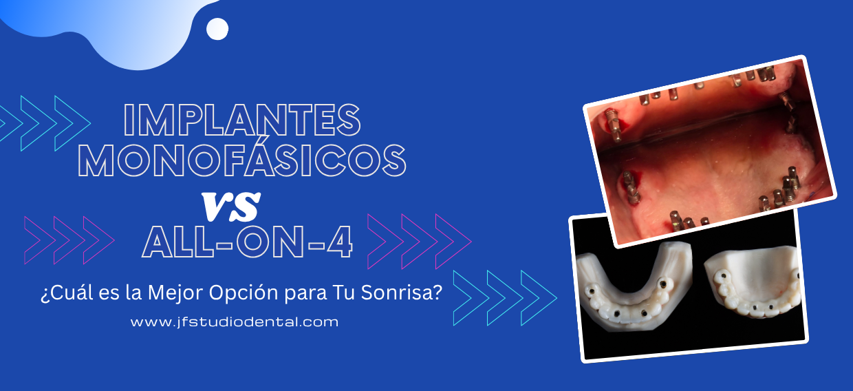 implantes dentales all-on 4 o implantes dentales monofásicos